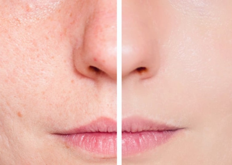 Ανάπλαση Ουλών Ακμής