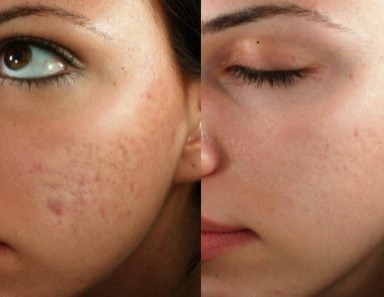 Ανάπλαση Ουλών Ακμής