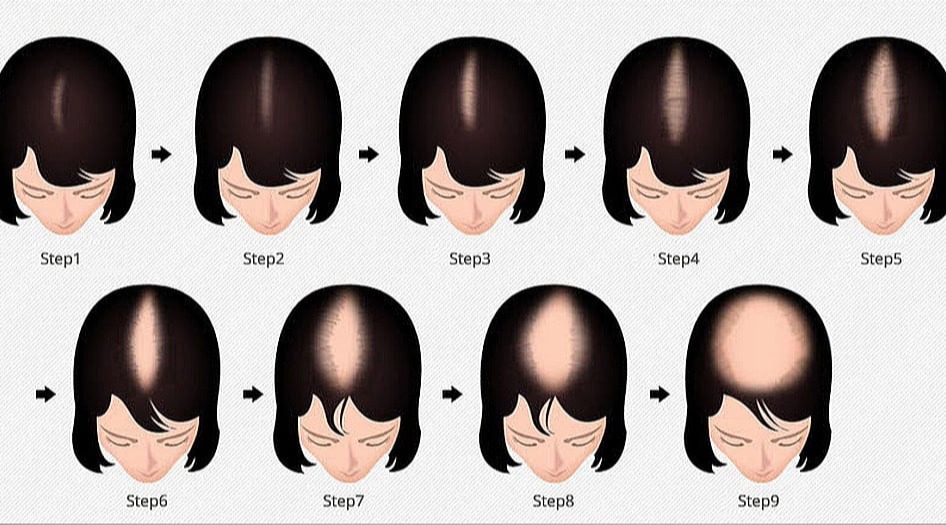 Ανδρογεννητική αλωπεκία