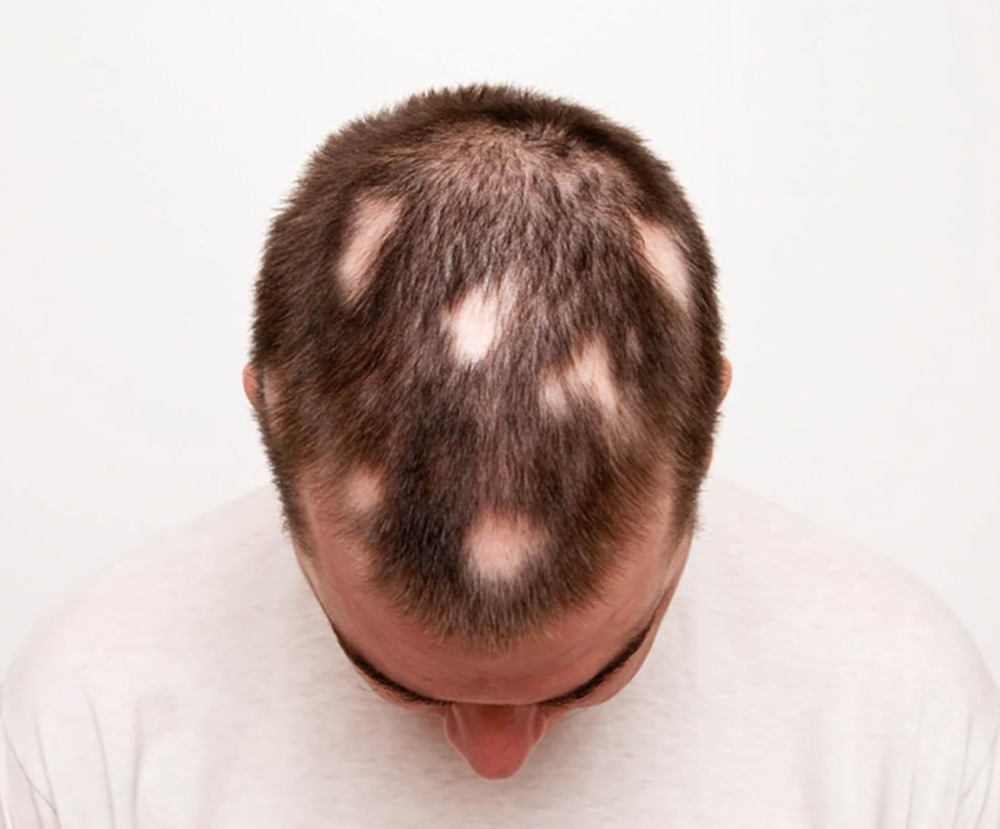 Γύροειδης αλωπεκία