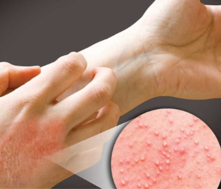 Ατοπική δερματίτιδα