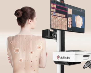 Ελεγχος σπιλών με δερματοσκόπηση-χαρτογράφηση