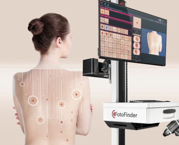 Ελεγχος σπιλών με δερματοσκόπηση-χαρτογράφηση