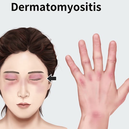 Δερματομυοσίτιδα