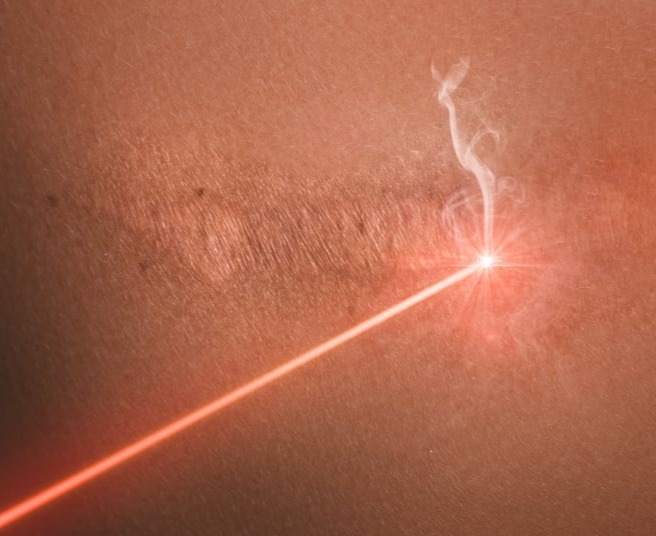 Εγκαύματα - Διόρθωση ουλών