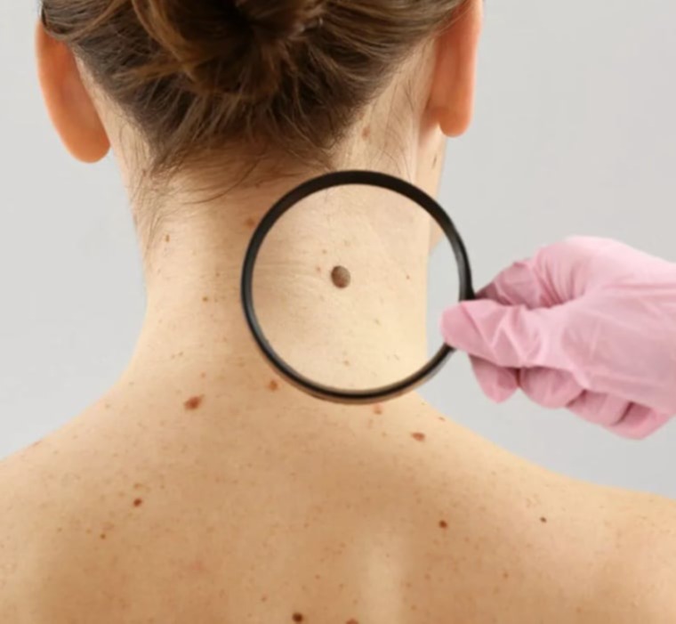 Ογκολογία δέρματος – ελιές