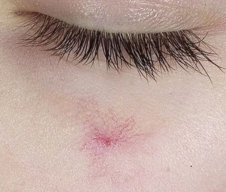 Ευρυαγγείες - Ερυθρότητα