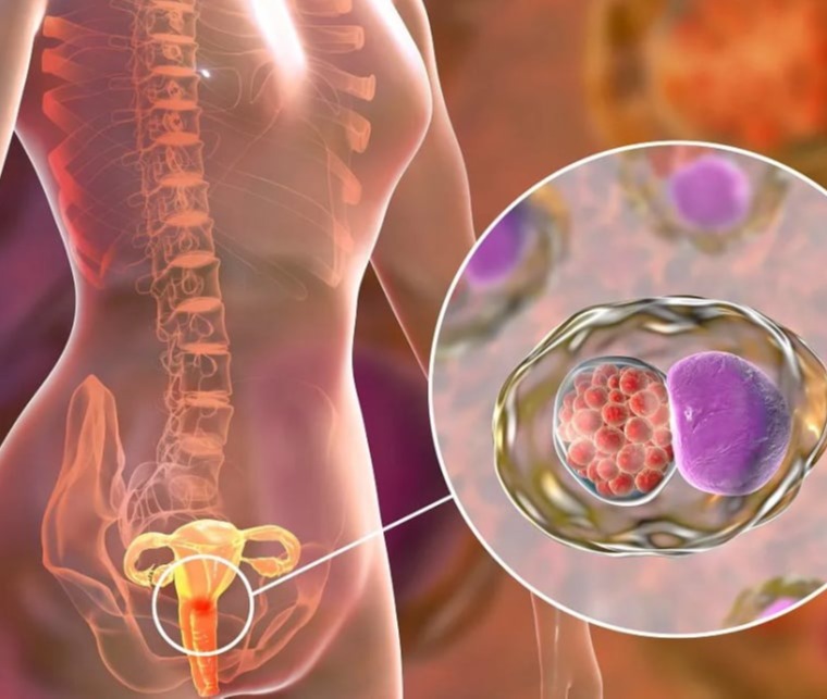 Χλαμύδια στις γυναίκες