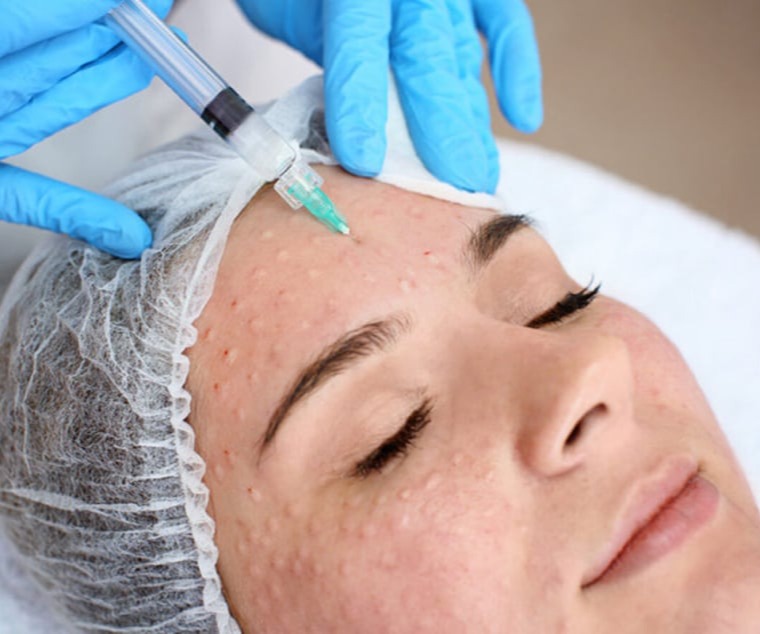 Υαλουρονικό Οξύ