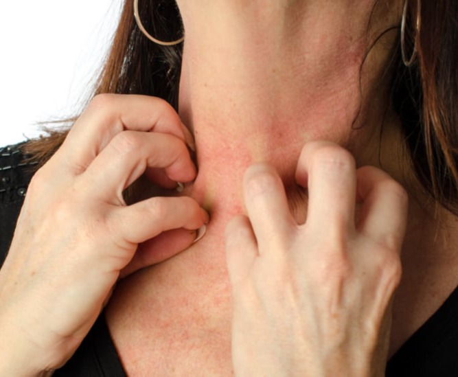 Κνίδωση, αυτοάνοση-αυθόρμητη