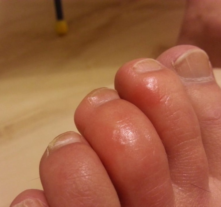 Κολπίτιδες από μύκητες