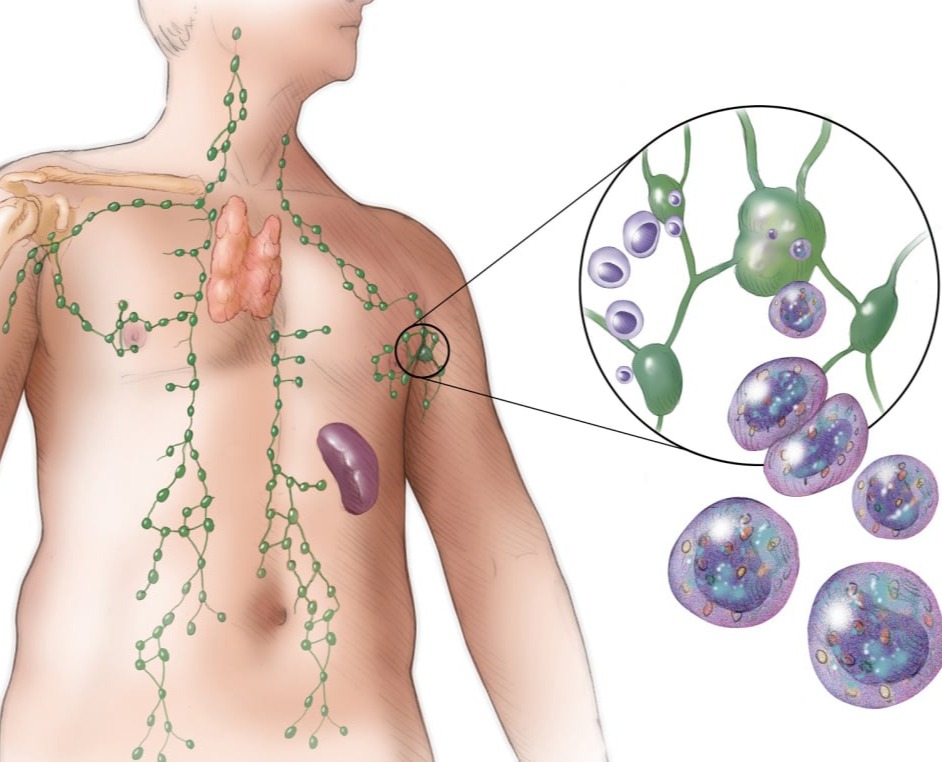 Δερματικά λεμφώματα