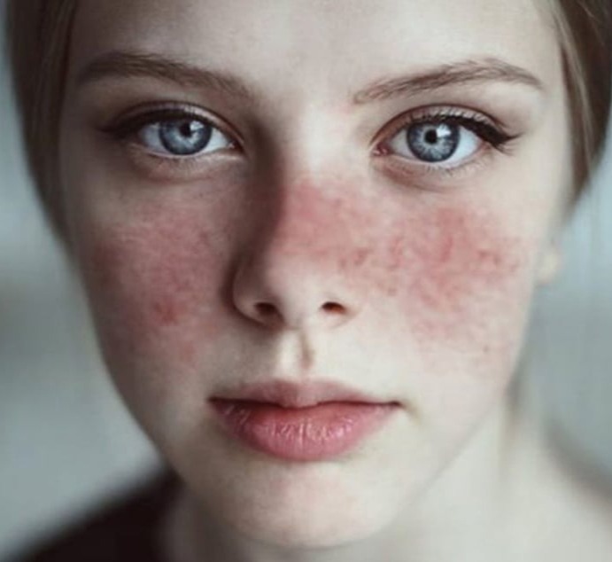 Ερυθηματώδη λύκο