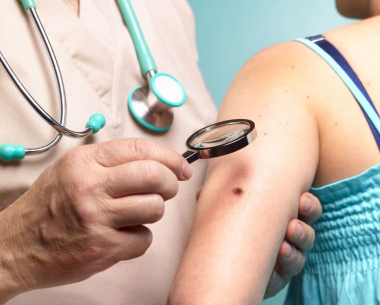 Καρκίνοι δέρματος – Μελάνωμα