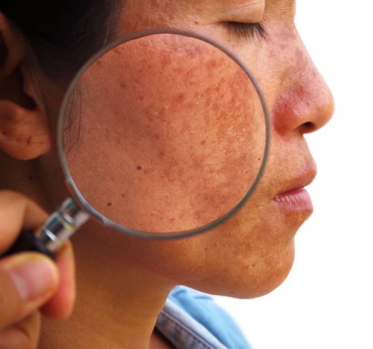 Κηλίδες – Μέλασμα