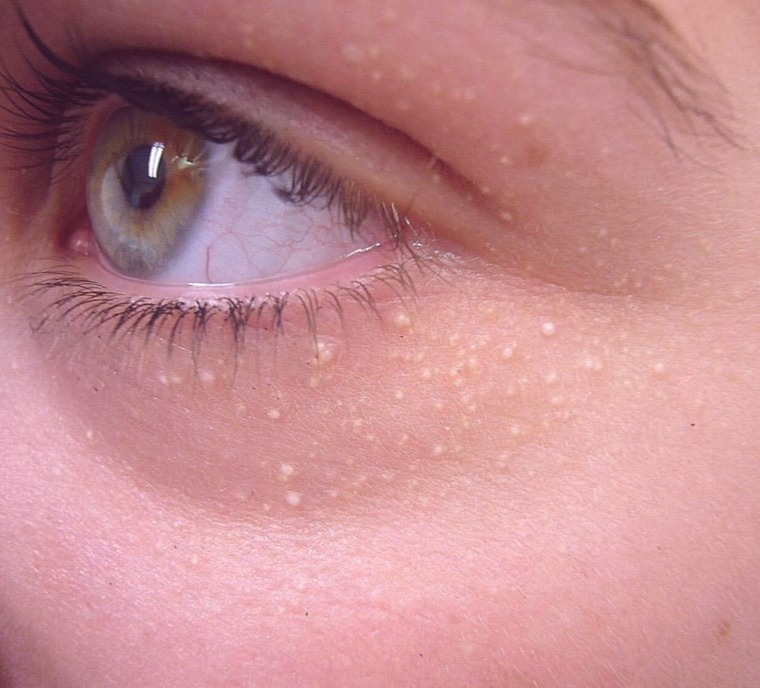 Μολυσματική τερμίνθος