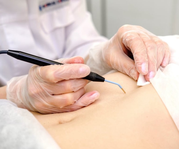 Η χειρουργική αποκατάσταση δερματικών βλαβών, όπως σπίλοι, όγκοι και κύστεις του δέρματος, είναι μια διαδικασία που συνήθως πραγματοποιείται από ειδικό χειρουργό, συνήθως από έναν δερματολόγο ή πλαστικό χειρουργό. Οι λόγοι για τη χειρουργική αποκατάσταση μπορεί να είναι πολλοί, και περιλαμβάνουν τόσο αισθητικούς όσο και ιατρικούς λόγους. Ορισμένα σημαντικά στοιχεία σχετικά με τη χειρουργική αποκατάσταση δερματικών βλαβών περιλαμβάνουν:  Αφαίρεση Σπίλων: Ορισμένοι ανθρωπολόγοι αποφασίζουν να αφαιρέσουν σπίλους για αισθητικούς λόγους ή επειδή υπάρχει κίνδυνος μετατροπής τους σε κακοήθη όγκο. Η αφαίρεση συνήθως γίνεται με τη χρήση λειζερ, κρυοχειρουργικής, ή αφαίρεσης με κίρσων, ανάλογα με τον τύπο του σπίλου. Αφαίρεση Όγκων και Κύστεων: Ογκώδεις μάζες και κύστεις του δέρματος επίσης μπορεί να χρειάζονται χειρουργική αφαίρεση για διάφορους λόγους. Αυτή η διαδικασία συνήθως περιλαμβάνει τον περιορισμό του όγκου και την απομάκρυνση του με γενική ή τοπική αναισθησία. Πλαστική Χειρουργική: Σε περιπτώσεις όπου η αποκατάσταση ενδέχεται να επηρεάσει την εμφάνιση, ειδικοί πλαστικοί χειρουργοί μπορεί να είναι χρήσιμοι για να ελαχιστοποιήσουν τα ίχνη και να βελτιώσουν την εμφάνιση της επηρεασμένης περιοχής. Πάντα είναι σημαντικό να συνεργαστείτε με εξειδικευμένο ιατρό που θα καθοδηγήσει την αποκατάσταση σύμφωνα με τις ανάγκες και τις προτεραιότητές σας.