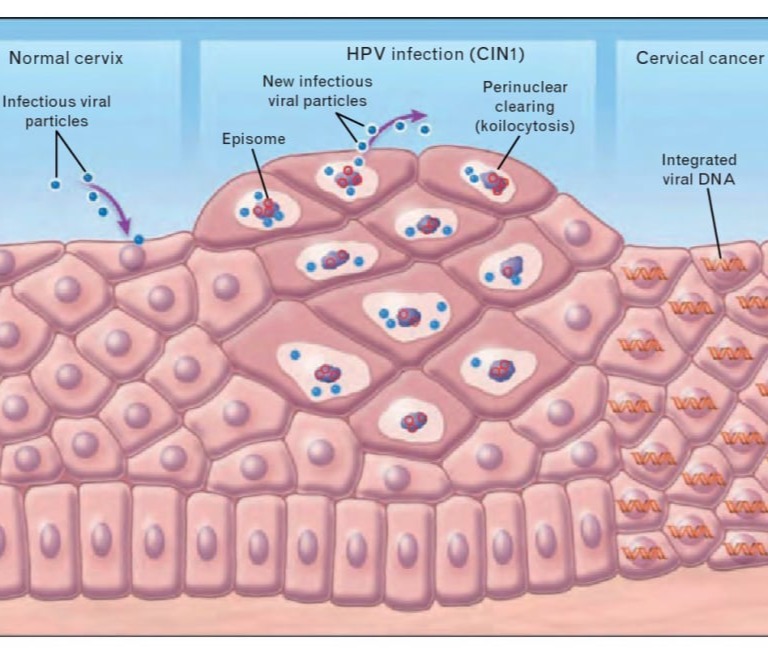 Κονδυλώματα HPV