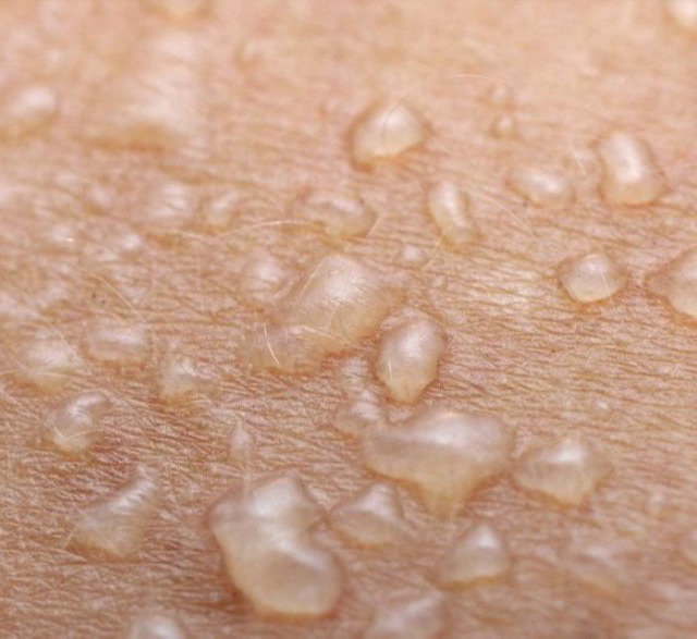 Πομφολυγώδη νοσήματα (Πέμφιγα και Πομφολυγώδες πεμφιγοειδές)