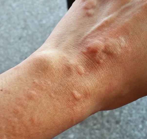 Θεραπεία Xolair omalizumab για ΚΝΙΔΩΣΗ, αυτοάνοση-αυθόρμητη