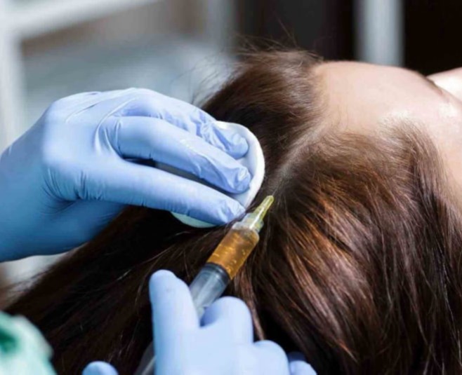 Θεραπεία - μέσοθεραπεία - PRP αλλοπεκίας