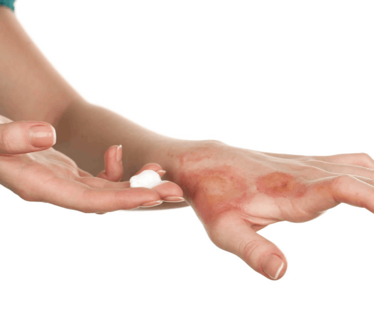 Σκληροδερμία