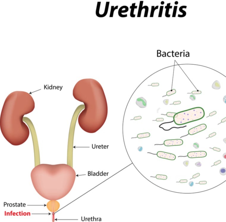 Ουρηθρίτιδες στους άνδρες